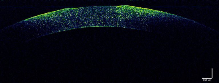 OCT Aufnahme einer Kaninchencornea in einer EVEIT Kammer, Nahaufnahme eines Spots ohne Epithel